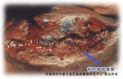 肛瘘，位于前列腺部位。